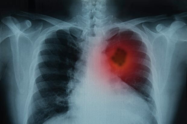 Wat zijn de symptomen van longkanker? Is er een behandeling voor longkanker? Om longkanker te voorkomen ...