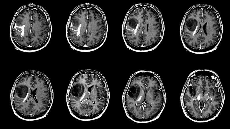 Wat veroorzaakt een hersentumor? Wat zijn de symptomen van een hersentumor? Is de behandeling van hersentumoren moeilijk?