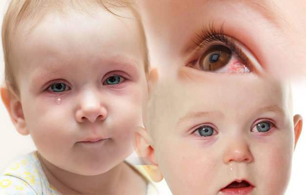 Waarom krijgen baby's ogen bloed? Hoe gaat oogbloedingen over bij een pasgeboren baby?