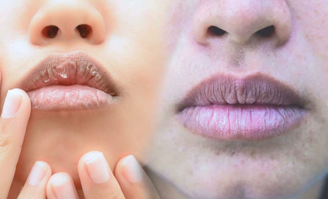 Wat veroorzaakt donkere lippen? Hoe wordt lipdonker worden of blauwe plekken behandeld?
