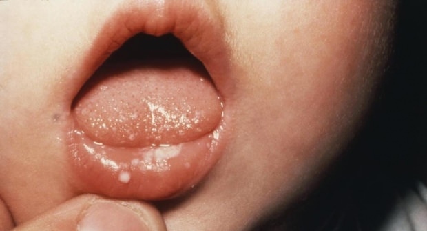 Hoe doet een mond pijn bij baby's