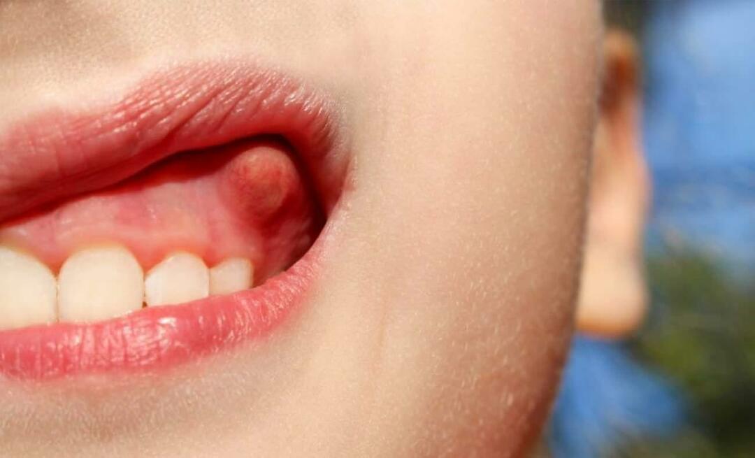 Waarom doet het tandabces en wat zijn de symptomen? Tandabces, hoe wordt het behandeld?