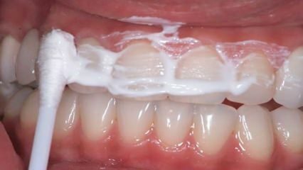 Maak je tanden binnen een week wit met dit mengsel!