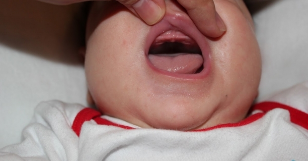 Wat is gehemelte-drop bij baby's, waarom? Symptomen en behandeling ...