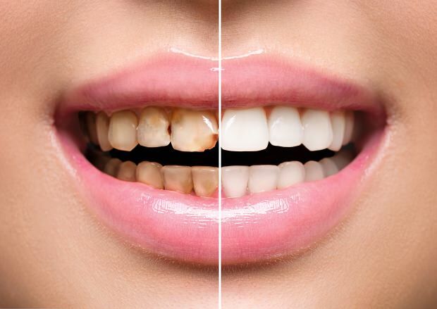 Als gevolg van ongezonde voeding treden zowel tandverkleuring als tandverlies op