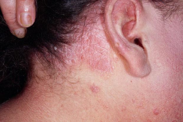 Wat zijn de symptomen van seborrheic dermatitis en voor wie lijkt het? Voedingsmiddelen die de ziekte veroorzaken