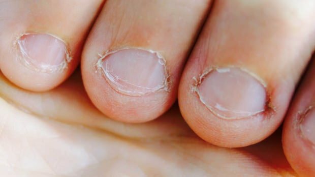 Wat is nagelziekte? Welke ziekten veroorzaakt het eten van nagels?