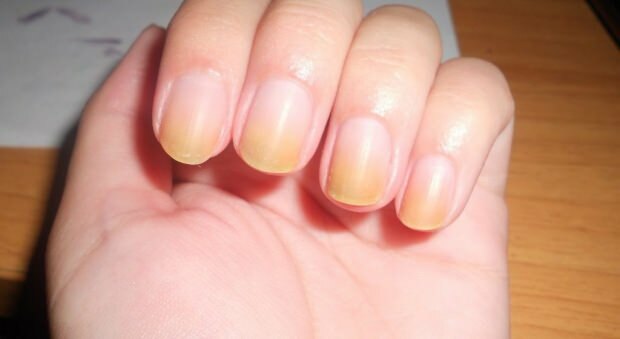 Oorzaken van vergeling van de nagel