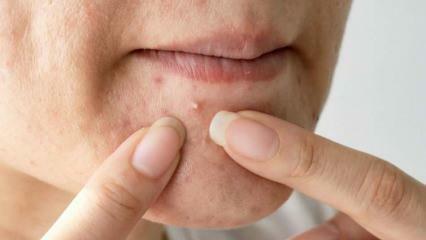 Waarom verschijnt acne op de kin? Natuurlijke oplossing voor acne op de kin