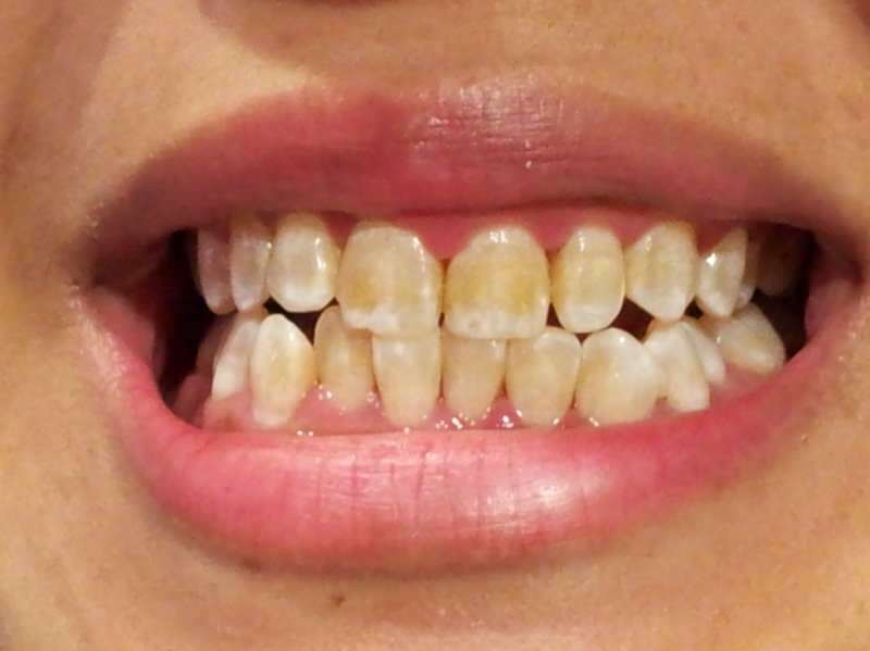 tandbeeld van een persoon wiens tanden donkerder worden