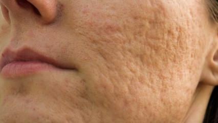Hoe gaan acnelittekens op het gezicht weg? Maskeer recepten die acnelittekens verwijderen