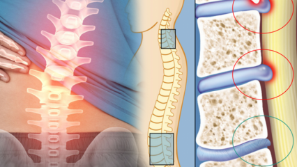 Wat is een vernauwing van het ruggenmerg? Wat zijn de symptomen van vernauwing van het ruggenmerg? Is er een remedie voor vernauwing van het ruggenmerg?