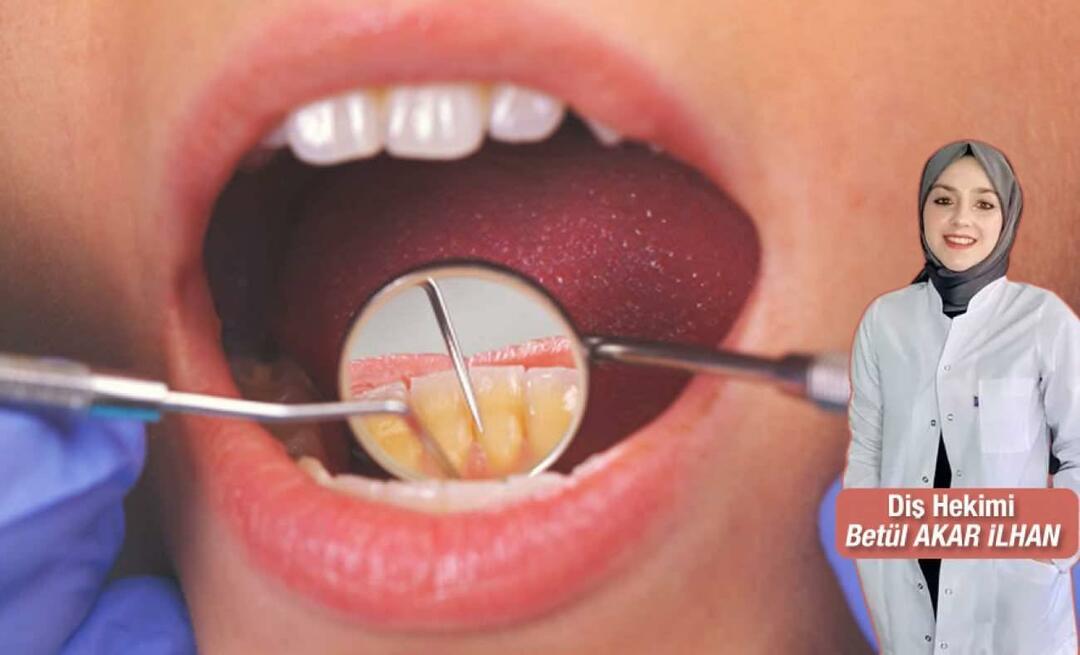 Wat te doen om tandsteen te voorkomen? Wat zijn de voordelen van tandsteenverwijdering?
