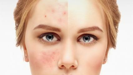 De meest effectieve en beste crèmes tegen acne in de apotheek 2021