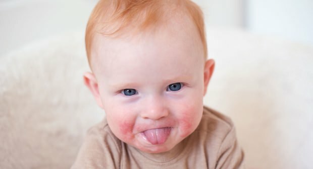 Let op bij baby's met rode wangen! Slapped cheek-syndroom en de symptomen ervan