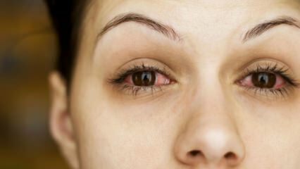 Wat is conjunctivitis (ooggriep) en wat zijn de symptomen? Hoe wordt conjunctivitis overgedragen?